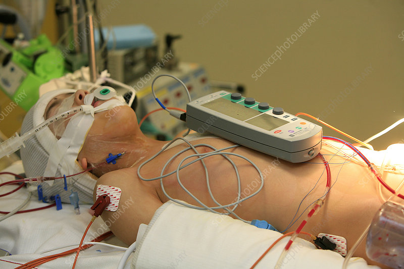 Réussite de l'implantation d'un stimulateur cardiaque chez une enfant