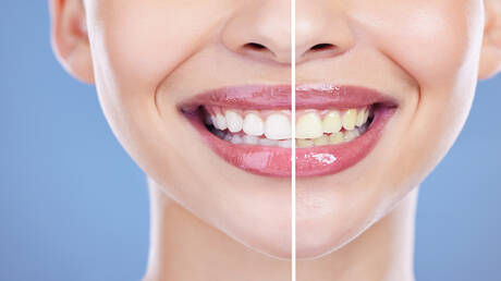 Poudre révolutionnaire pour blanchir les dents efficacement