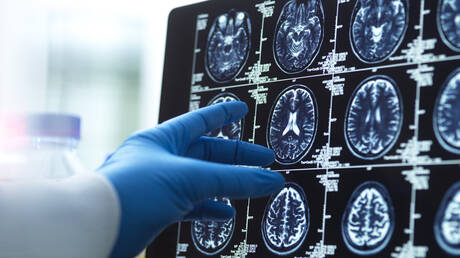 Brain Training Games Reduce Dementia Risk