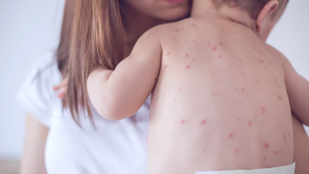 Indonesia Reports 93% Decrease in Measles Cases