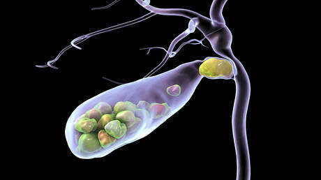 Study: Sugar and Increased Gallstone Risk