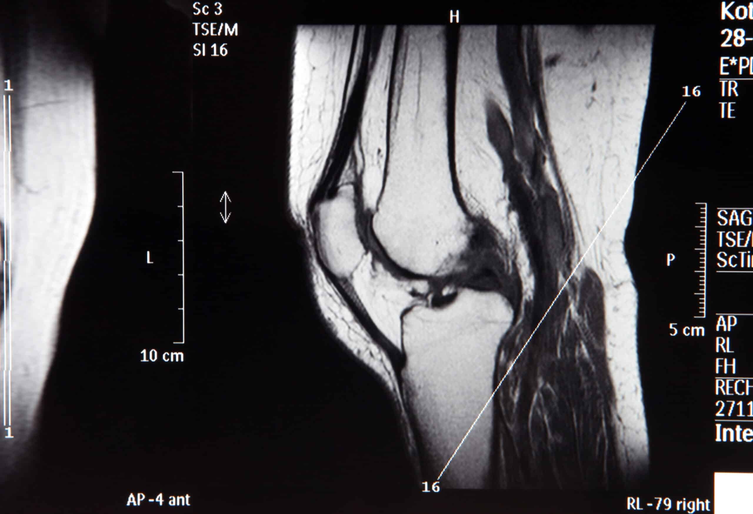 اكتشاف جديد في علاج التهاب المفاصل