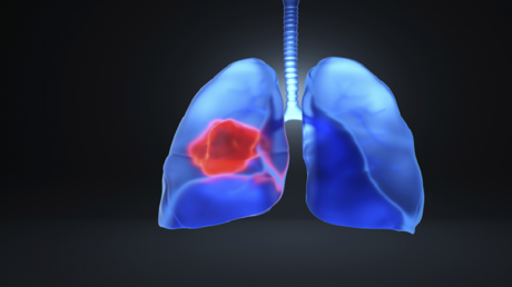 New Russian Technology for Lung Cancer Diagnosis