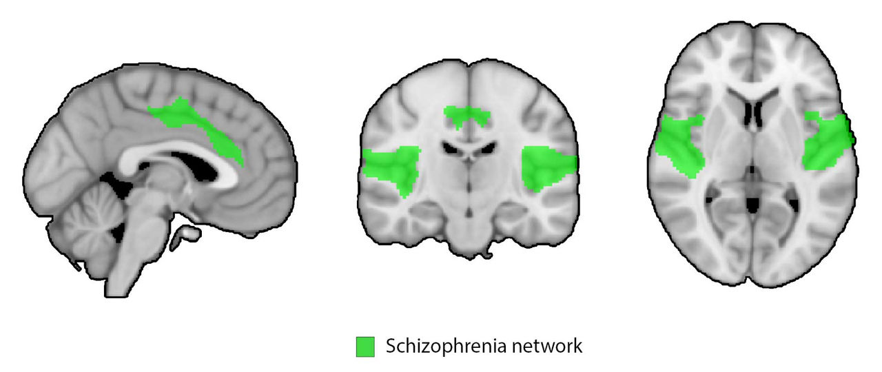 Découverte d'une protéine cérébrale pour traiter la schizophrénie