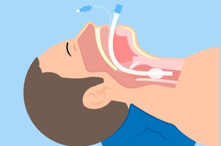 استخراج جسم غريب من الشعب الهوائية لطفل بالدقهلية