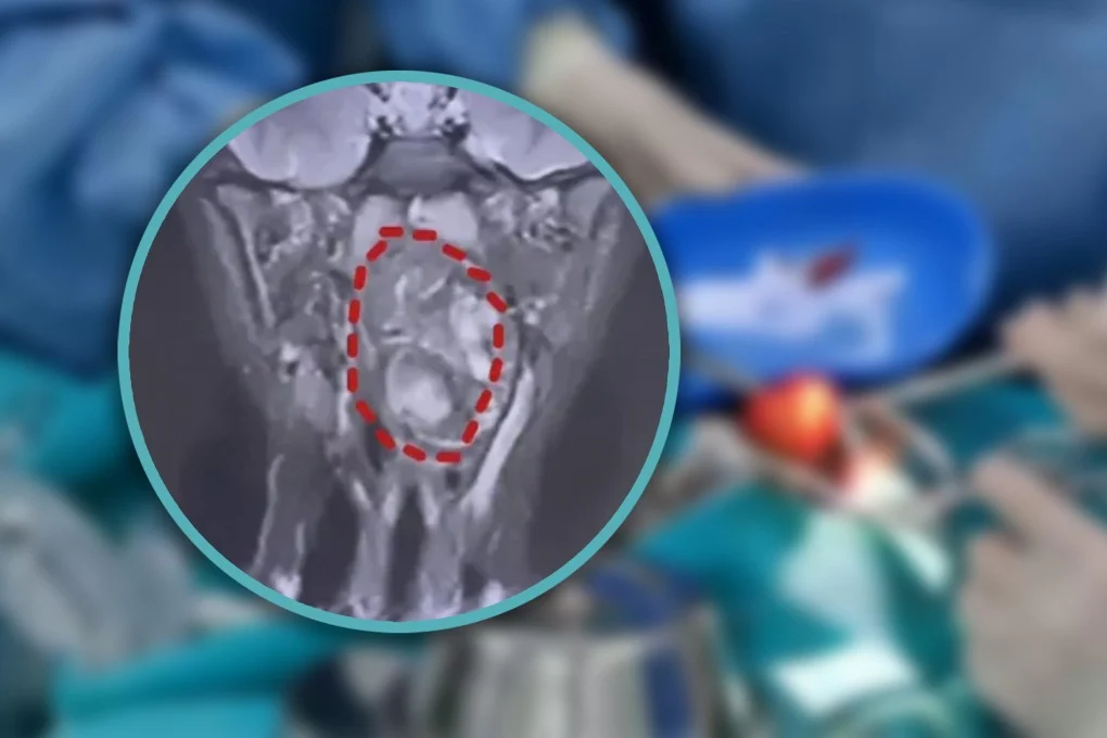 طفل صيني يعاني من ورم في الحلق يُعتقد أنه توأم غير مكتمل