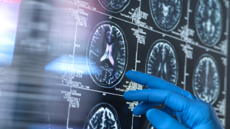 أعراض الخرف المبكرة وكيفية التعرف عليها