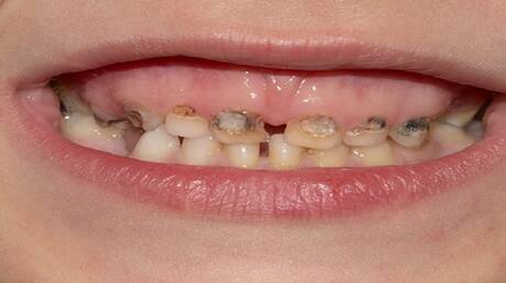 Passivrauchen und seine Auswirkungen auf Kinderzähne