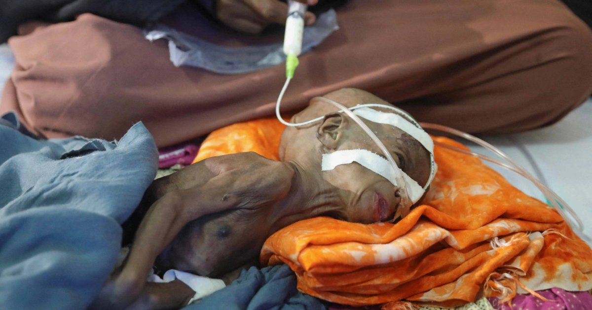 أزمة غذائية حادة تهدد أطفال الصومال