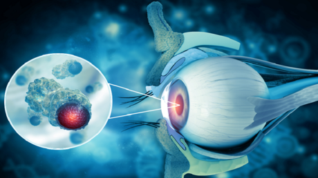 ابتكار جديد لعلاج سرطان العين لدى الأطفال