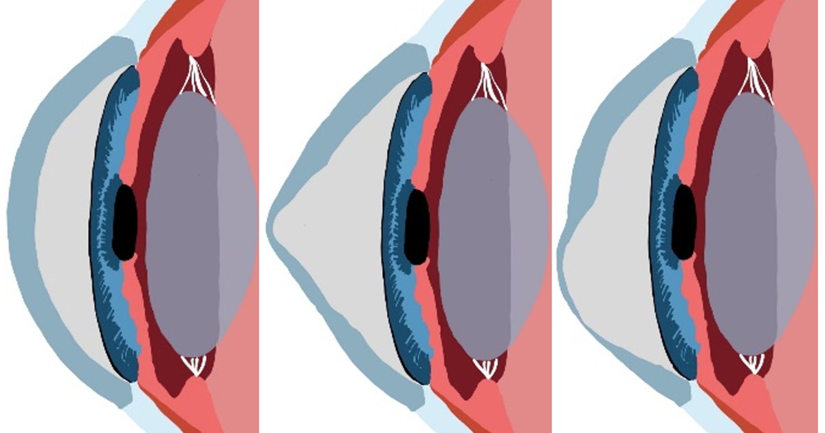 Fachkonferenz zum Keratokonus am Institut für Augenforschung