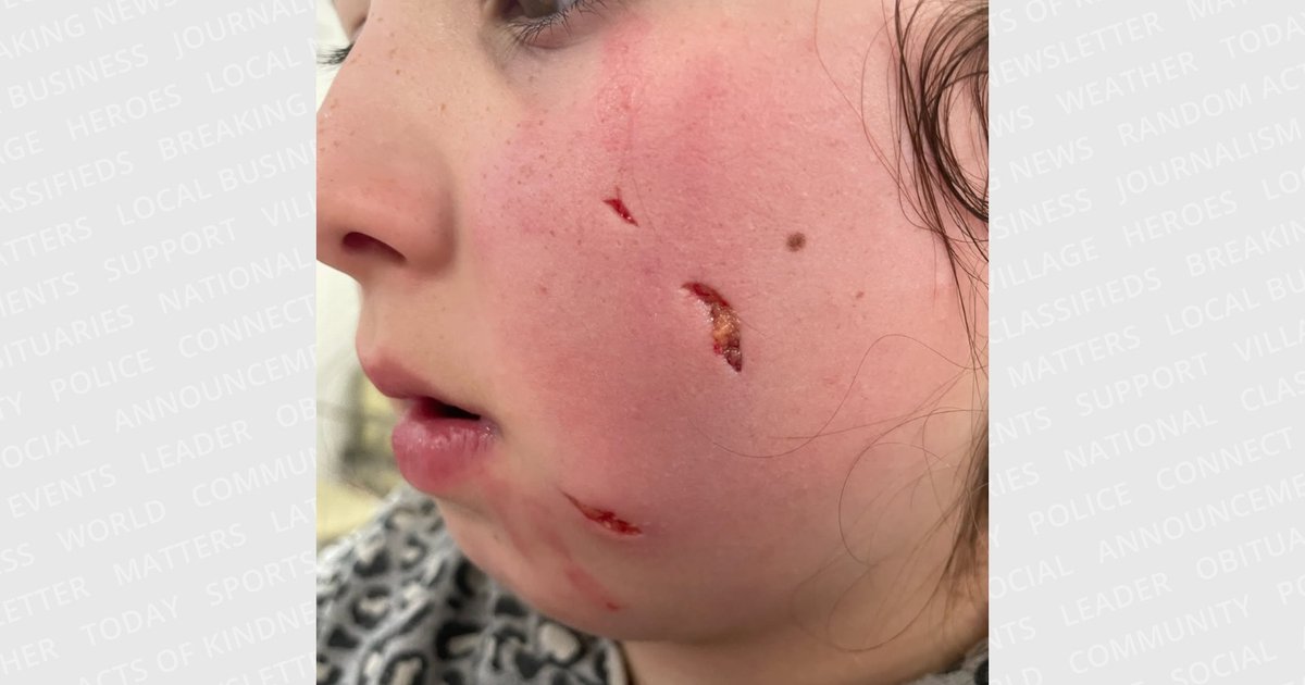 Stray Dog Bites Child in Kafr Jais, Irbid