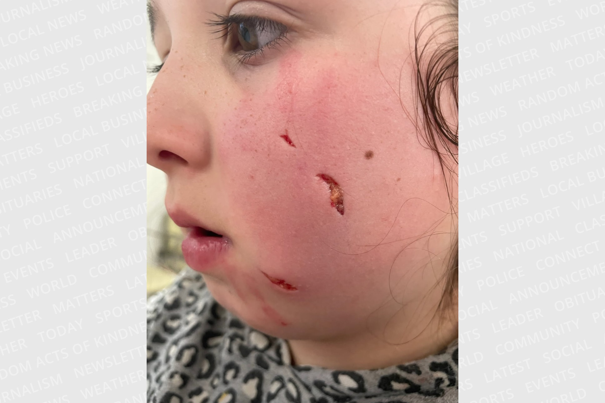 كلب ضال يعقر طفلاً في كفر جايز بإربد