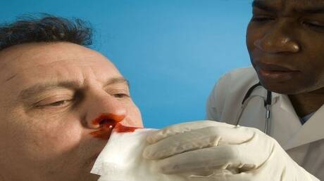 أسباب نزيف الأنف وأهم العوامل المؤثرة