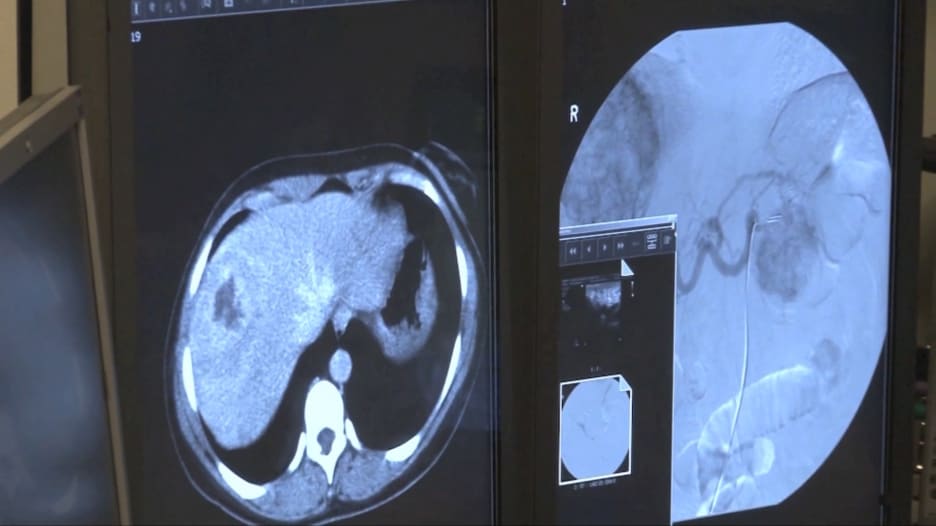 Gebruik van Viagra voor zeldzame neurologische aandoening