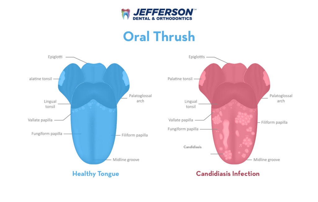 فطريات اللسان: الأعراض والعلاج