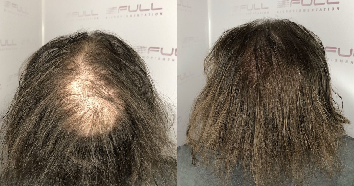 การรักษาด้วยความเย็น: เทคนิคใหม่ในการเพิ่มความหนาของเส้นผม