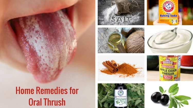 Remèdes maison pour traiter les mycoses buccales naturellement