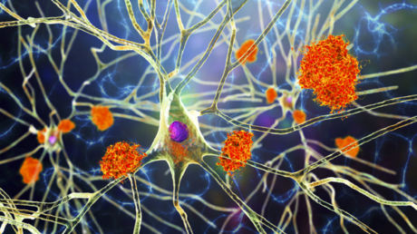 تدهور الذاكرة لدى مرضى ألزهايمر بسبب انخفاض الدوبامين