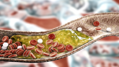 Natural Foods to Lower Cholesterol in Weeks