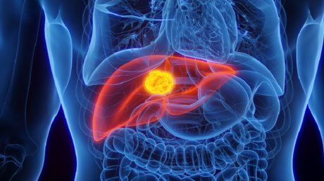 New Software for Early Detection of Liver Cancer