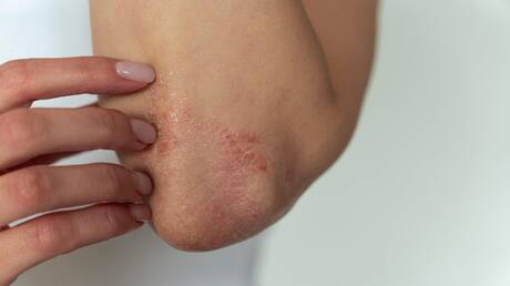 التهاب الجلد التأتبي وتأثيره على النوم والذاكرة